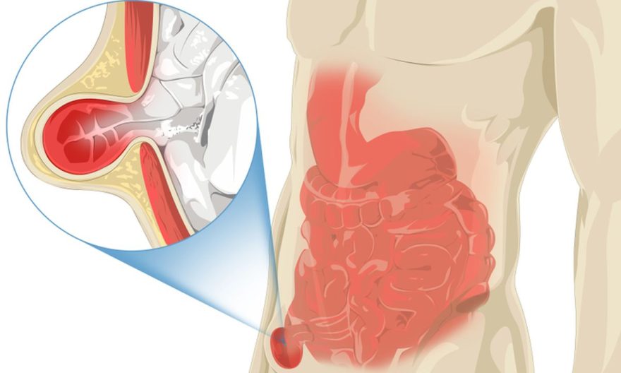 Penyakit Hernia dan Gaya Hidup yang Perlu Diperhatikan